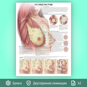 Плакат «Что такое рак груди?» (ЗОЖ-31, 1 лист, А2)